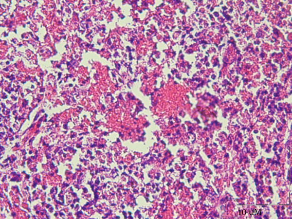 Excisional Biopsy of the Cervical Lymph Node Showing the Necrotic Area Devoid of Polymorphonuclear Leukocytes (H and E, × 40.)