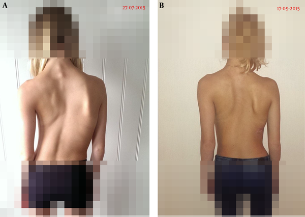 A, Before starting treatment with a GBW; B, Six weeks after starting treatment (see also https://bestpracticebracing.wordpress.com/bracing-scoliosis/).