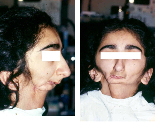 Lateral and Front Photographs of the Patient, Before Anesthesia
