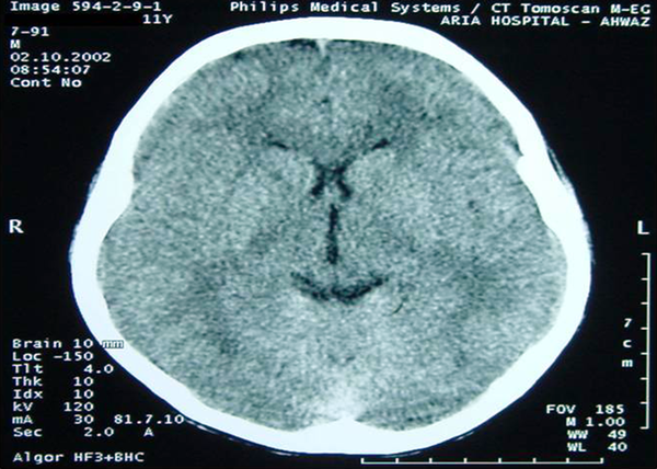 Normal Brain CT Scan of the Patient