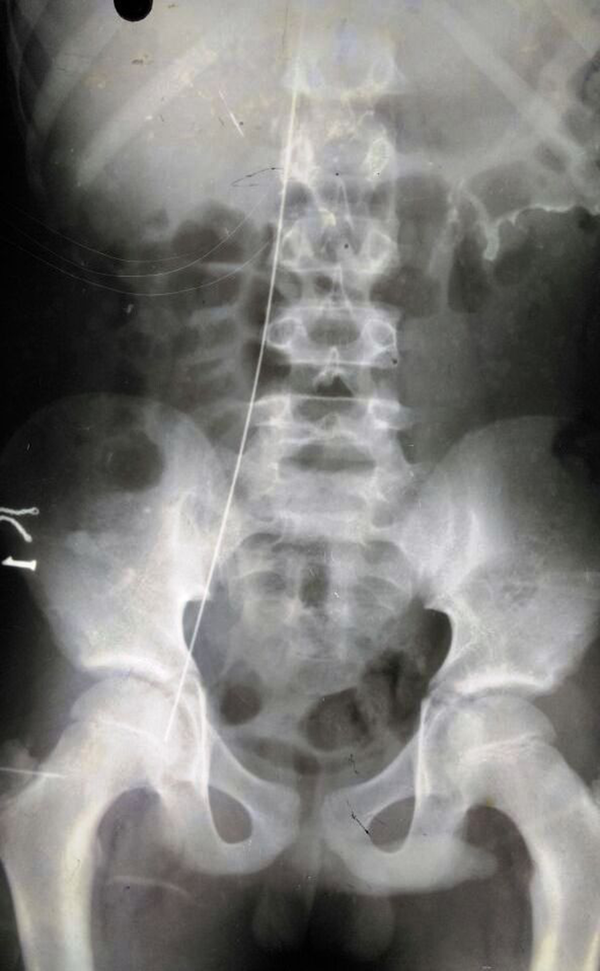 Shows retained guidewire from a central venous catheter extending from the right femoral vein and crossing the diaphragm to reach the right ventricle.