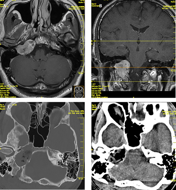 Axial and Coronal Preoperative MRI With Contrast of the Patient (A, B) and Postoperative CT Scan (C, D)