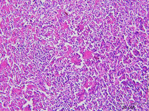 A Staining, Irregular Area Consisting of Minimal Necrosis, Surrounded by a Wide Zone of Immunoblasts and Histiocytes (H and E, × 20)