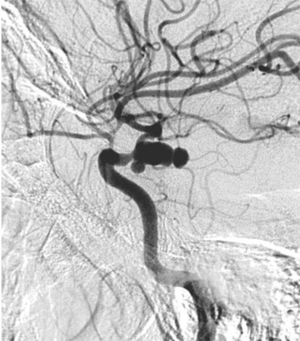 Four Vessel Angiogram Picture Showing Multilobulated Irregular Shaped PCOM Aneurysm
