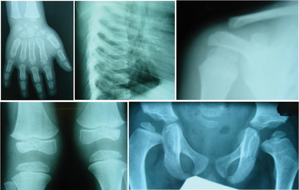 Radiographic Findings: X-ray Films Demonstrating Beaking of Thoracic Vertebrae, Generalized Epiphyseal Dysplasia and Osteopenia of the Ribs, Hand, Knees, and Pelvis (Skeletal System)