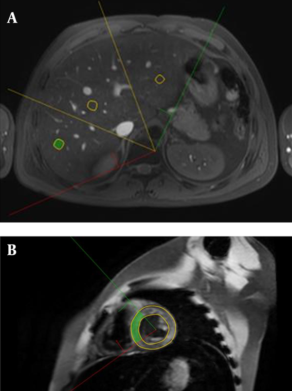 A, T2* measurement of the right lobe of the liver with free-hand ROI is shown; B, T2* measurement of the interventricular septum in a thalassemia patient with severe cardiac iron deposition with free-hand ROI including endo-, myo- and epicardial layers is shown. T2* decay curve is under the 0.9 of R-square value.