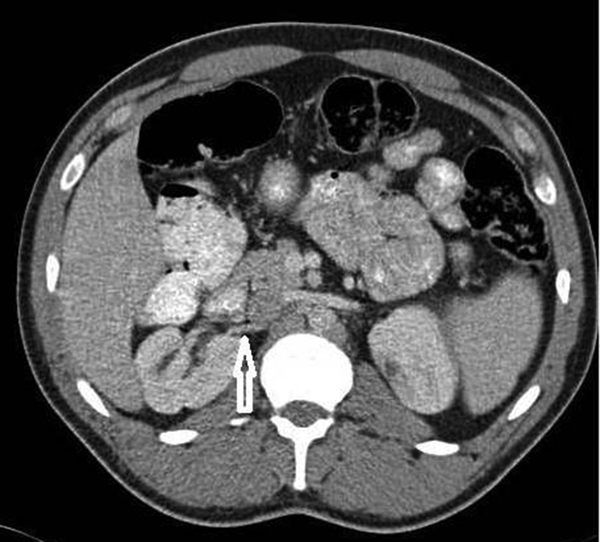 Axial CT image shows the artery of the right lower kidney originating from the abdominal aorta (white arrow).