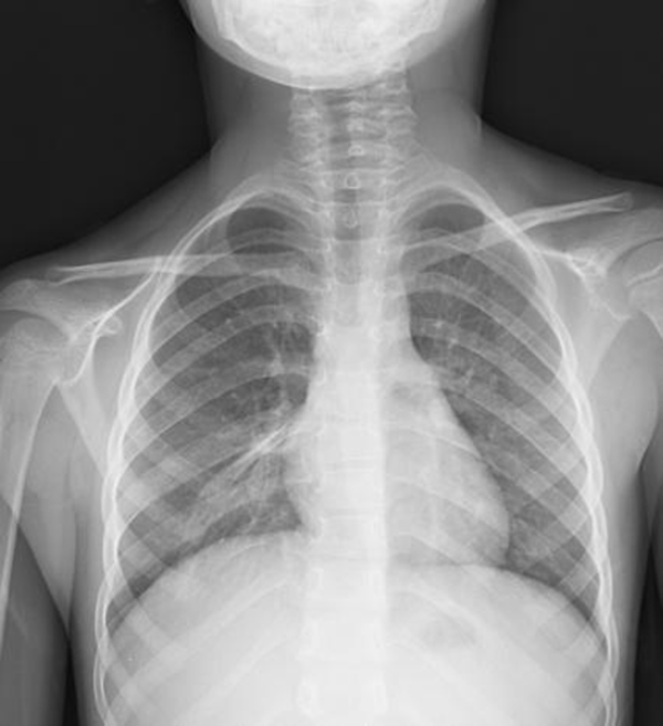 Chest X-ray; right perihilar hyperlucent appearance