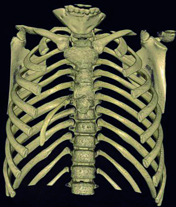 Spiral CT, anterior appearance. A right intrathoracic rib which is articulated on the anterior aspect of the T7 vertebral body and protrudes into the thorax cavity causing collapse of the lower lung parenchyma
