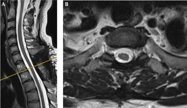 Showing status post complete resection of the tumour, with the transverse view revealing a normal volume of the spinal cord where it had been displaced by the tumour.