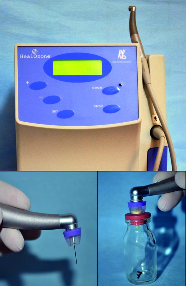 Application Technique of Silicone Caps and Endodontic Cannulas to the Teeth