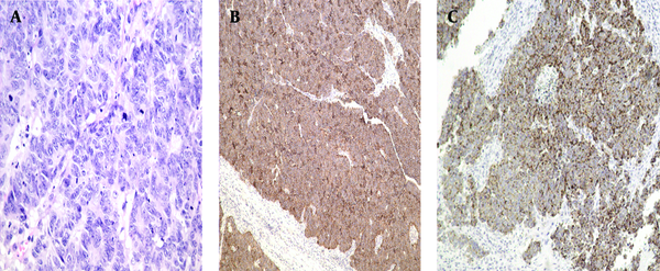 Pathology shows the lesion with small tumor cells arranged in irregular nests with infiltrative growth and increased mitotic activity (A: H&amp;E×400). Immunohistochemically, the tumor was positive for CD56 (B: EliVision™× 100), and CHGA (C: EliVision™× 100).