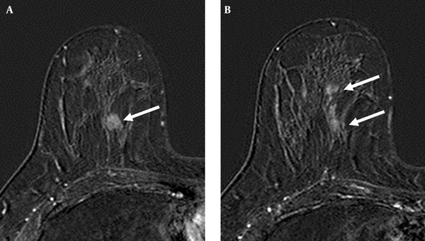 A 52-year-old woman with A, invasive ductal carcinoma in the upper inner quadrant of right breast (arrow); B, The axial post-contrast subtracted image shows heterogeneous linear enhancement (arrows) in the same quadrant as the index cancer. The surgical biopsy revealed ductal carcinoma in situ.