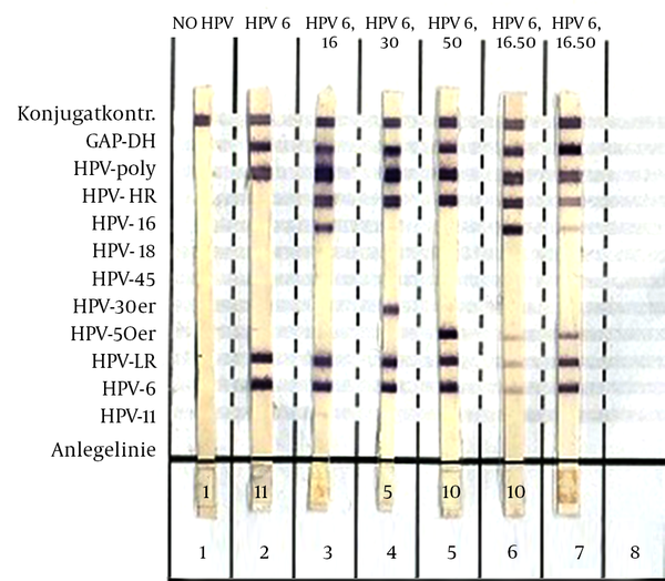 (Autoimmun Diagnostika GmbH, Strassberg, Germany), showing no HPV and the different HPV genotypes in single and multi infections detected in cervical specimens.