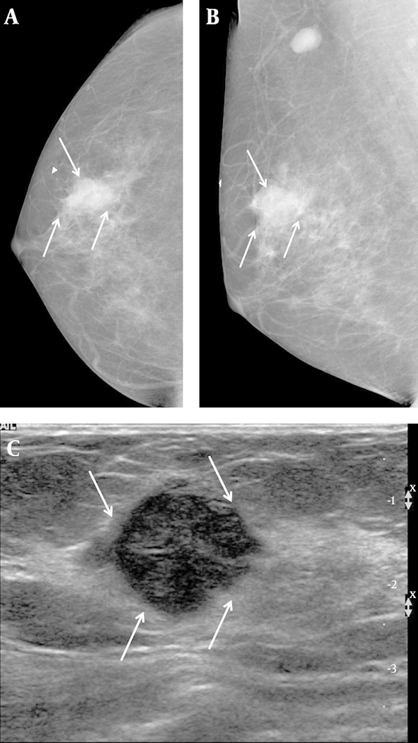 A 57-year-old woman complained of a palpable mass in her right breast. A, Right craniocaudal and B, Mediolateral oblique views on mammography showed an indistinct margin, with a round mass and without calcifications on the BB marker site in the right upper outer area (arrows). An enlarged lymph node is also seen in the right axillary area. C, Transverse ultrasound revealed a hypoechoic mass that was microlobulated with a round shape (arrows), and which we categorized as BI-RADS category 4b. US-CNB was performed, and the case was confirmed to be medullary carcinoma. The patient underwent breast-conservation surgery and was subsequently labeled as a histologic grade 3, TNBC. TNBC: Triple-negative breast cancer; US-CNB: Ultrasound-guided core needle biopsy