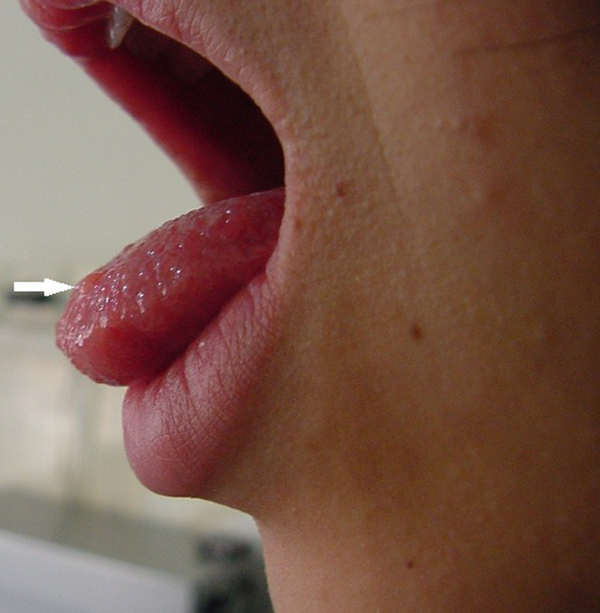 Numerous Neurinomas on her Lip and Tongue