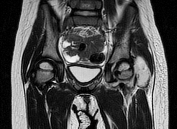 MRI Coronal T2 Sequence Showing Left Hip Effusion and a Periarticular Collection in Relation With Gluteus Minimus