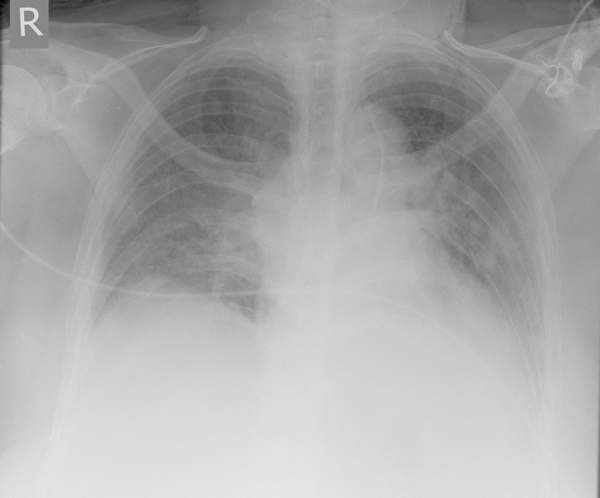 A Chest X-ray showing the malposition of a left internal jugular central venous catheter down the left internal mammary (thoracic) vein