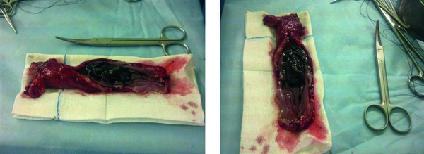 The sample was from the distal part of the esophagus. Note the polypoid black pigmented lesion