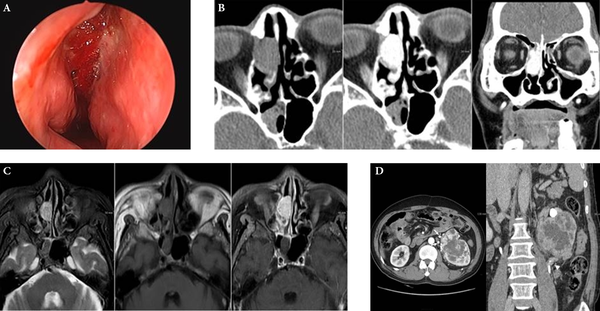 Sixty two-year-old man with nasal metastasis from silent renal cell carcinoma. A, On nasal endoscopy, a hyperemic and hemorrhagic nasal lesion occupying the right middle meatus was noted; B, Axial CT scan showed an oval-shaped, soft-tissue-density mass in the right ethmoid sinus, extending into the nasal cavity with avid enhancement; C, On MRI, a 2.2 cm, oval-shaped, right sinonasal mass appeared hyperintense on T2WI and isointense on T1WI, with strong enhancement; D, On contrast-enhanced 3D CT images of the kidneys, a heterogeneously enhancing lobulated mass measuring 9.7 × 8.5 cm was found in the upper polar region of the left kidney. Round high-densities represent prominent vascular collaterals. The tumor mass engulfed the left proximal ureter with irregular luminal narrowing (arrowhead).