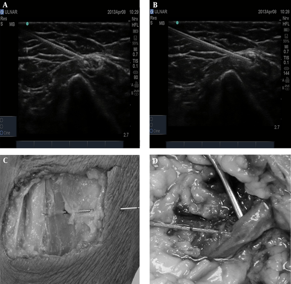 Illustrating the ultrasonography-guided needle placement (2A and 2B, perineural and intraneural injections, respectively) and the corresponding dissections to confirm the need position (2C and 2D, perineural and intraneural injections, respectively)