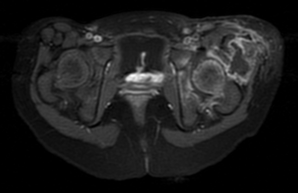 MRI Axial T1 Fat Suppression Sequence After IV Gadolinium Showing Peripheral Enhancement of Periarticular Collection and Extensive Osteoarticular and Muscular Signal Changes