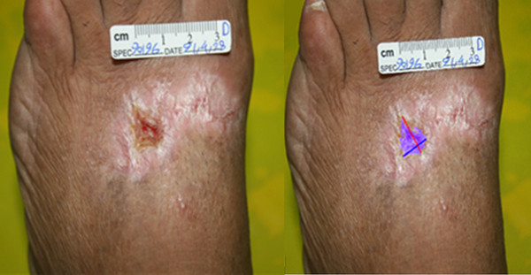 Patient 2, 10 Weeks After Treatment With Fibroblast