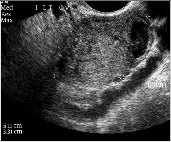 A 22-year-old gravida 1, para 0 woman with a left hemorrhagic ovarian cyst. Prepregnancy transvaginal ultrasound shows a 5 cm well-defined left-sided complex adnexal mass with thick walls, regular margins of mixed solid and cystic components with low-level internal echoes. No internal septations and no ascites was noted. A normal appearing left ovary is not seen separate from this mass. Diagnosis of hemorrhagic ovarian cyst was initially made.
