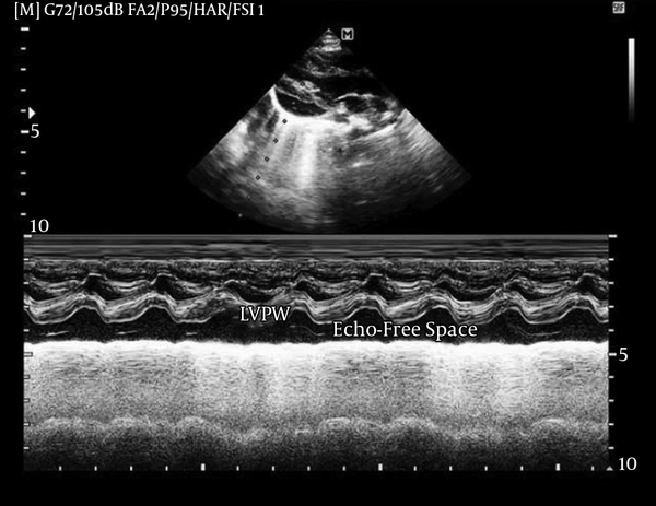 An echo-free space mimicking a pericardial effusion is seen posterior to the left ventricular free wall. This is in fact, the retro-left ventricular segment of the Congenital Giant Right Atrial Aneurysm (CGRAA).