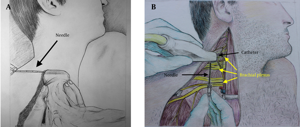 A) In-Plane Approach, B) Out-of-Plane Approach. The Skin Has Been Peeled Away to Show The Underlying Brachial Plexus and Possible Spatial Relationship Between The Catheter After it is Inserted and The Superior Portions of The Plexus