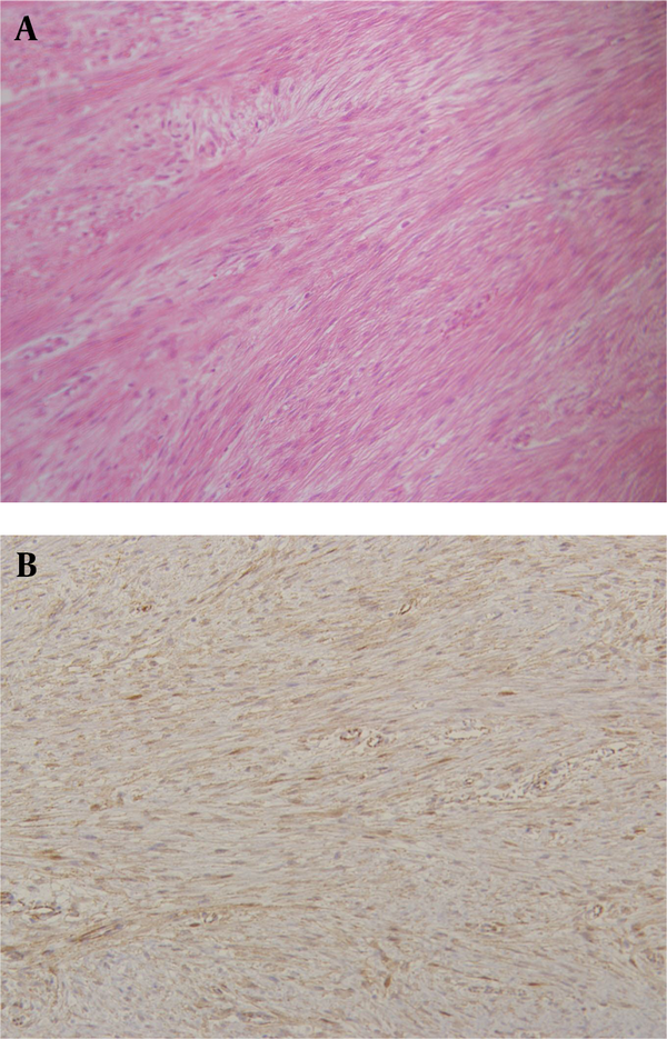 Histological specimen with hematoxylin and eosin (A) and beta-catenin staining (B). The tumor is composed of collagen fibers and spindle cells that stain positive for beta-catenin, consistent with a desmoid tumor.