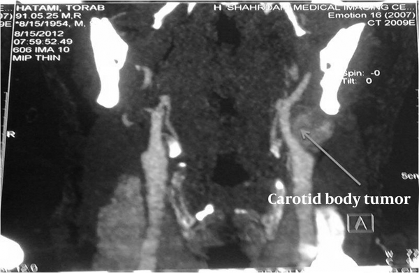 The Carotid Body Tumor in CT Angiography