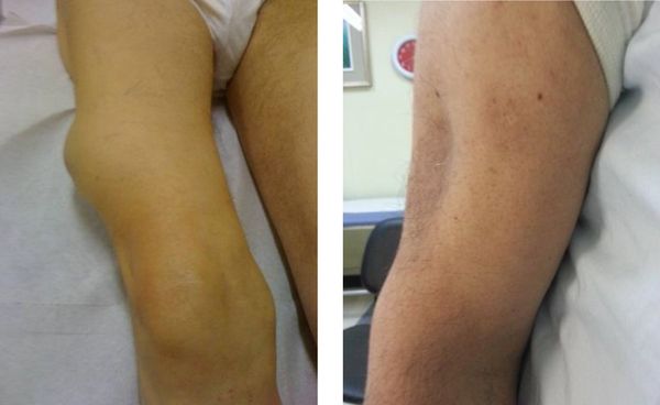 LH Lesion of the Right Thigh (Left Panel) and LA Lesion of the Left Arm (Right Panel)