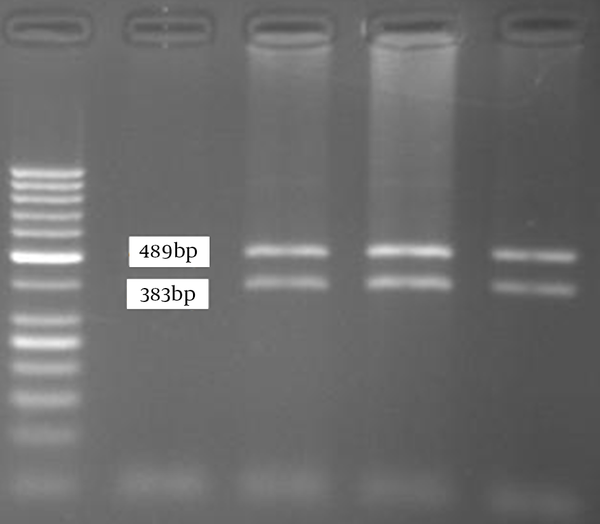 The Results of AciI Digestion for the Detection of p.R469W