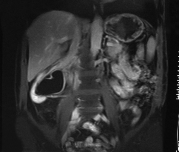 Coronal T1-weighted fat-suppressed contrast-enhanced MR image of the patient one month after surgery. There is no residual mass around the inferior vena cava.