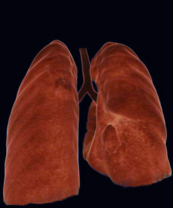 Collapse of the lower lung parenchyma on the right side