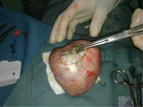 The Bigger Size Dermoid Cyst From Left Ovary (the Cyst Wall Was Opebed After the Surgery to Evaluate Contents)
