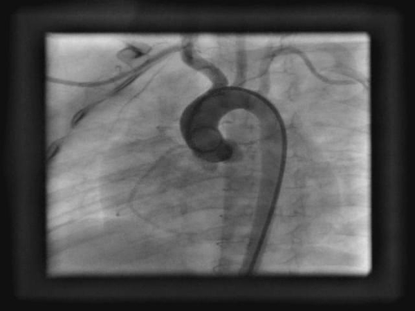 Angiographic View Demonstrates Normal Aortic Arch With no Evidence of Patent Ductus Arteriosus