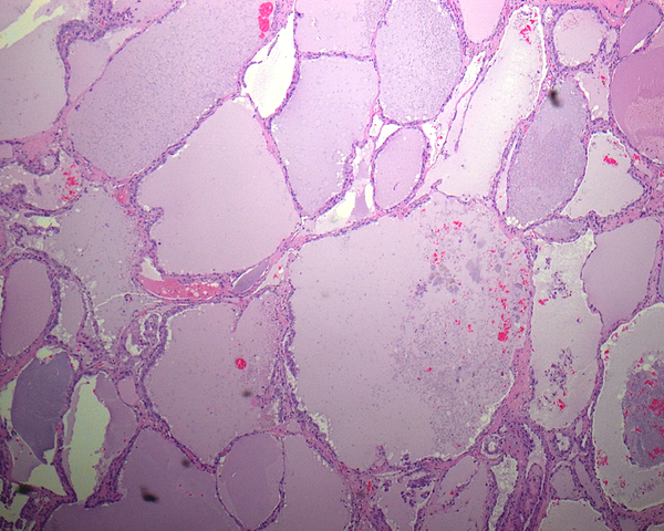 At this magnification, the tumor could be confused with a macrofollicular adenoma or multinodular goiter. (Hematoxylin and Eosin staining, original magnification 50×).