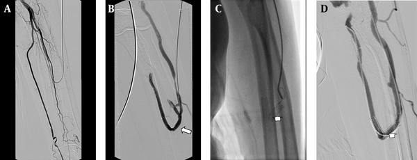 A 75-year-old man with radiocephalic access in the left forearm in place at the third day after PTA; A, Fistulogram shows occlusion of the distal radial artery. B, The metallic stent 6×40 mm deployed at the radial artery and the cephalic vein; the fistulogram shows the blood supply at this access (arrow). C, The follow-up venogram obtained after 8 months with the retrograde catheterization shows laceration of the stent (arrow). D, Angiogram shows patency of the stent and the access (arrow), an additional interventional procedure is not required.