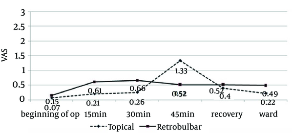 Comparing Pain Intensities Based on VAS Scale in Time Intervals in the Two Groups of Cataract Surgery (Phaco) Using Topical Anesthesia and Retrobulbar Block