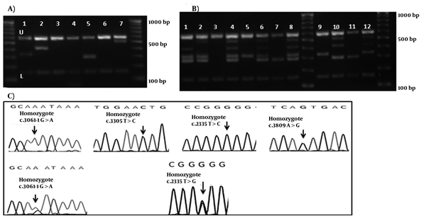 (A) Gel electrophoresis of Set 1, U: upper and L: lower controls are depicted for all lines. 3rd, 4th, and 6th wells show bands for the normal DNA. 100bp DNA ladder is depicted in right and left. Using Mix Set 2, Samples in 1st, 2nd, 5th, and 7th wells show the band for c.3061-1G &gt; A, c.3305T &gt; C, c.2335T &gt; G, and c.3809A &gt; G mutations, respectively. (B) Gel electrophoresis of the DNA bands of the hetero- and homozygote c.2335T &gt; G, and c.3061-1G &gt; A mutations. 1: the normal DNA with Set 2A. 2 and 3: heterozygotec.3061-1G &gt; A mutation. 4 and 5: heterozygote c.2335T &gt; G mutation; 6 and 7: homozygote c.3061-1G &gt; A mutation. 8 and 9: homozygote c.2335T &gt; G. 100bp DNA ladder is depicted in middle and left. (C) Chromatograms of main mutation detected in Set 1.