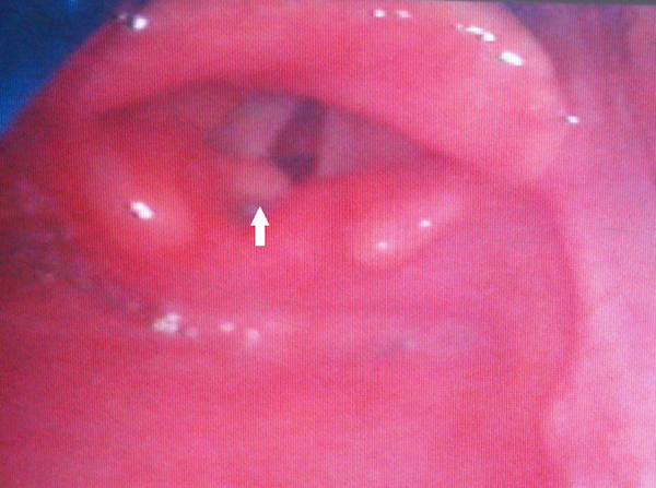 A Yellow-White Lesion Seen in Front of the Left-Sided Vocal Cord