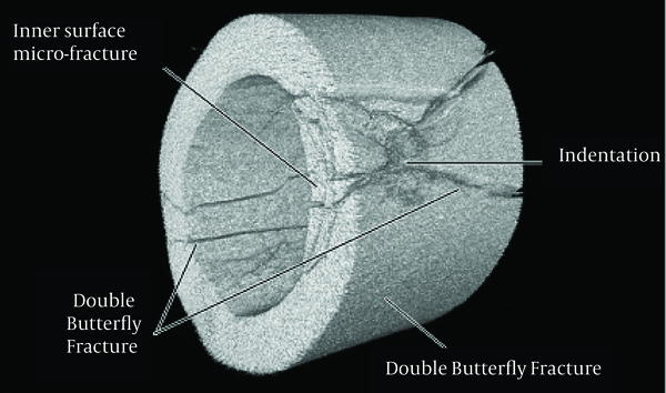 Micro-CT Image of the Impact Site of a Deer Femur Shot at 180 ft/s (54.5 m/s), Showing Deeper and More Extensive Indentation Damage, the Double Butterfly Fractures Extending Onto the Far Cortex Towards One Another and Progression of the Shockwave Comminution