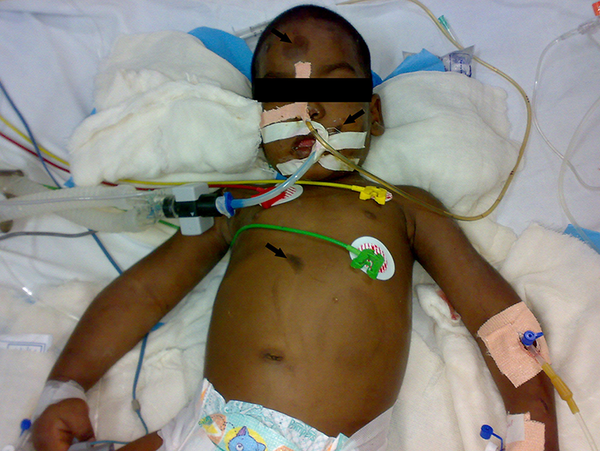 Child with Multiple Bruises (arrows)