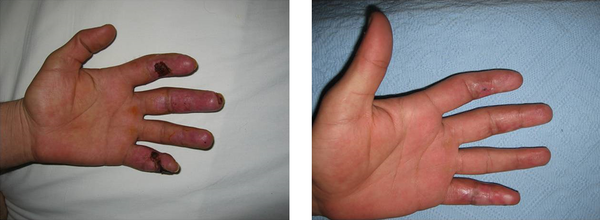 This case [Case-6] was healed uneventfully with medical dressing.