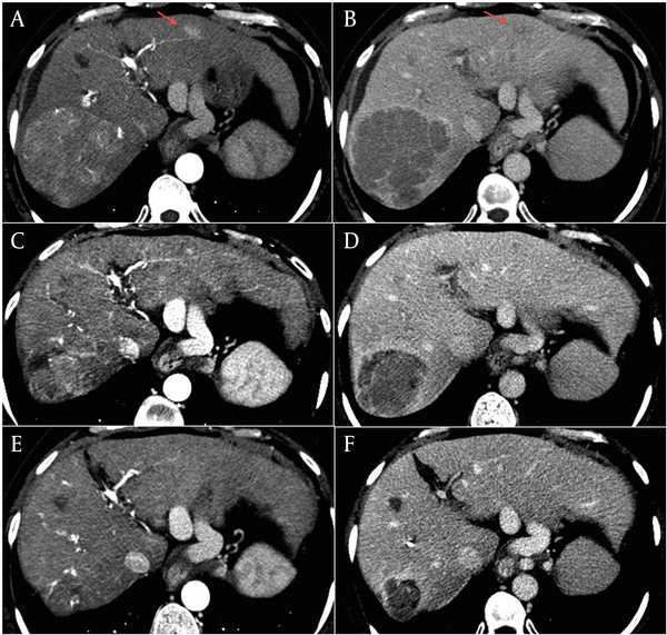 Note that the HCC lesion detected in the segment II (arrows in panels A and B) was also markedly reduced at the first CT control (C and D), and was no longer clearly distinguishable from the surrounding tissue at the last radiologic control (C and D).