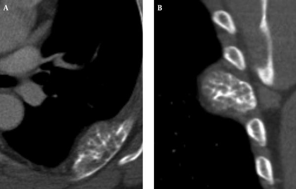 Axial contrast-enhanced chest CT image (A) and coronal reformation image (B) show an osteolytic eccentric expansive mass in the posterolateral part of the left sixth rib with sunburst calcification and focal cortical disruption.