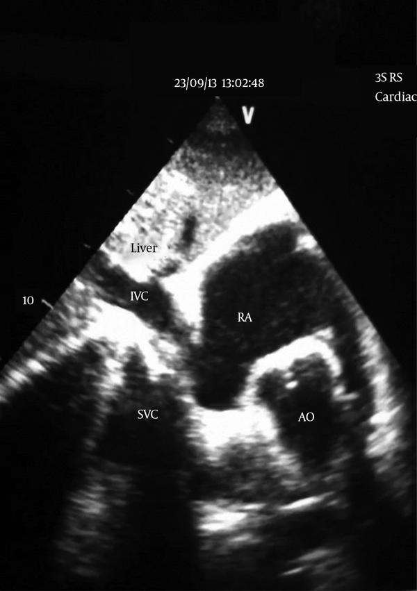 Image is taken from a video clip recorded with the handycam. AO, aorta; IVC, inferior vena cava; RA, right atrium; SVC, superior vena cava.