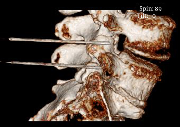 Three-Dimensional Computed Tomography Reconstruction Image of the Facet joints With PRF Cannula Adjacent to the Facet joint